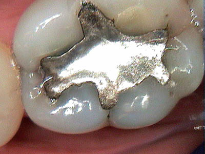 intraoral dental camera image